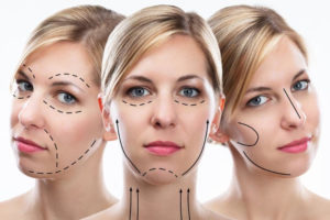 face neck lift